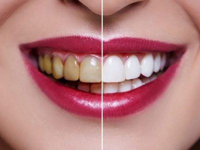 types-of-dental-veneer-best-type-of-veneer-materials
